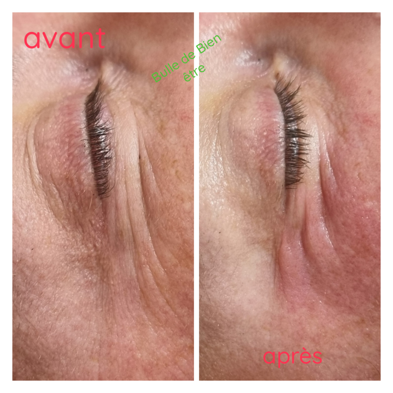 Madhérotérapie visage 